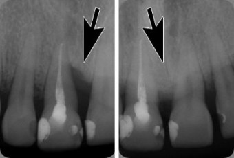 Levá fotografie - Parodontální chobot - ztráta kostní tkáně