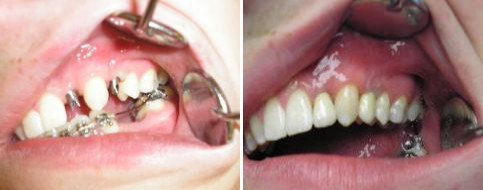 Náhrada dvou nezaložených zubů implantátem a metalokeramickou korunkou